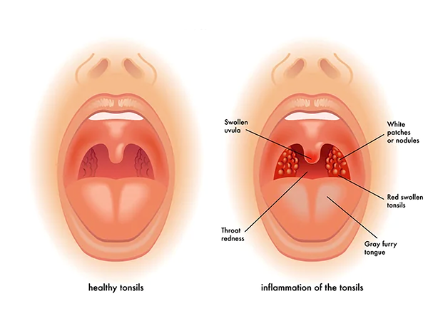 Sore Throat