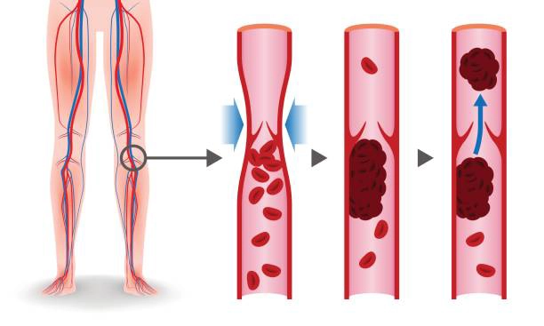 Blood Clots