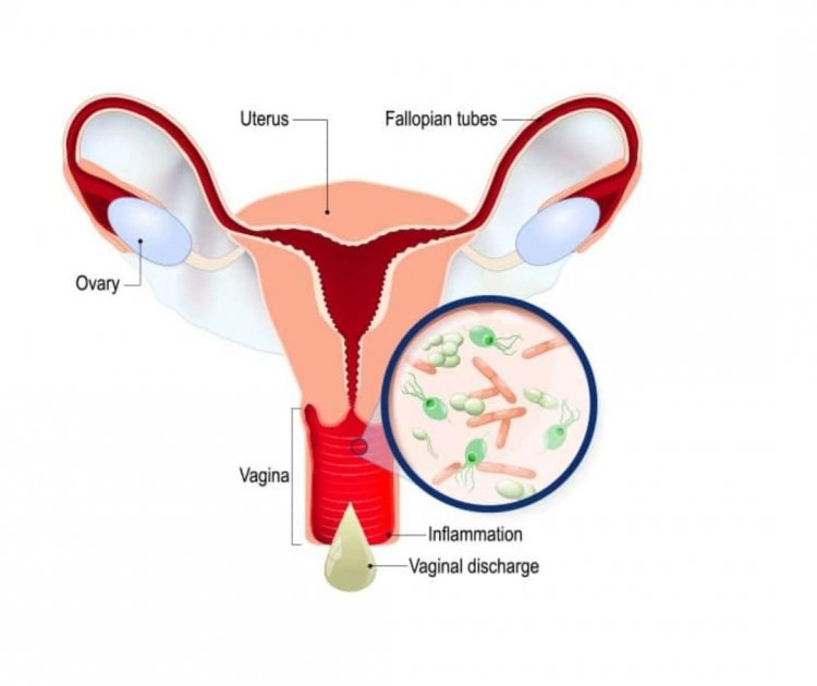 Bacterial Vaginosis