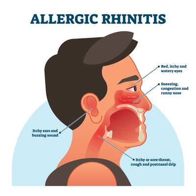 Allergic rhinitis image