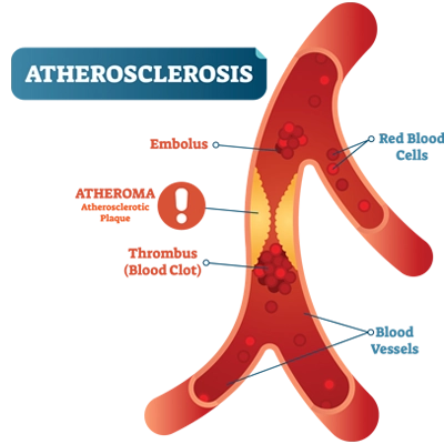 Atherosclerosis image