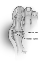 Acute Gout